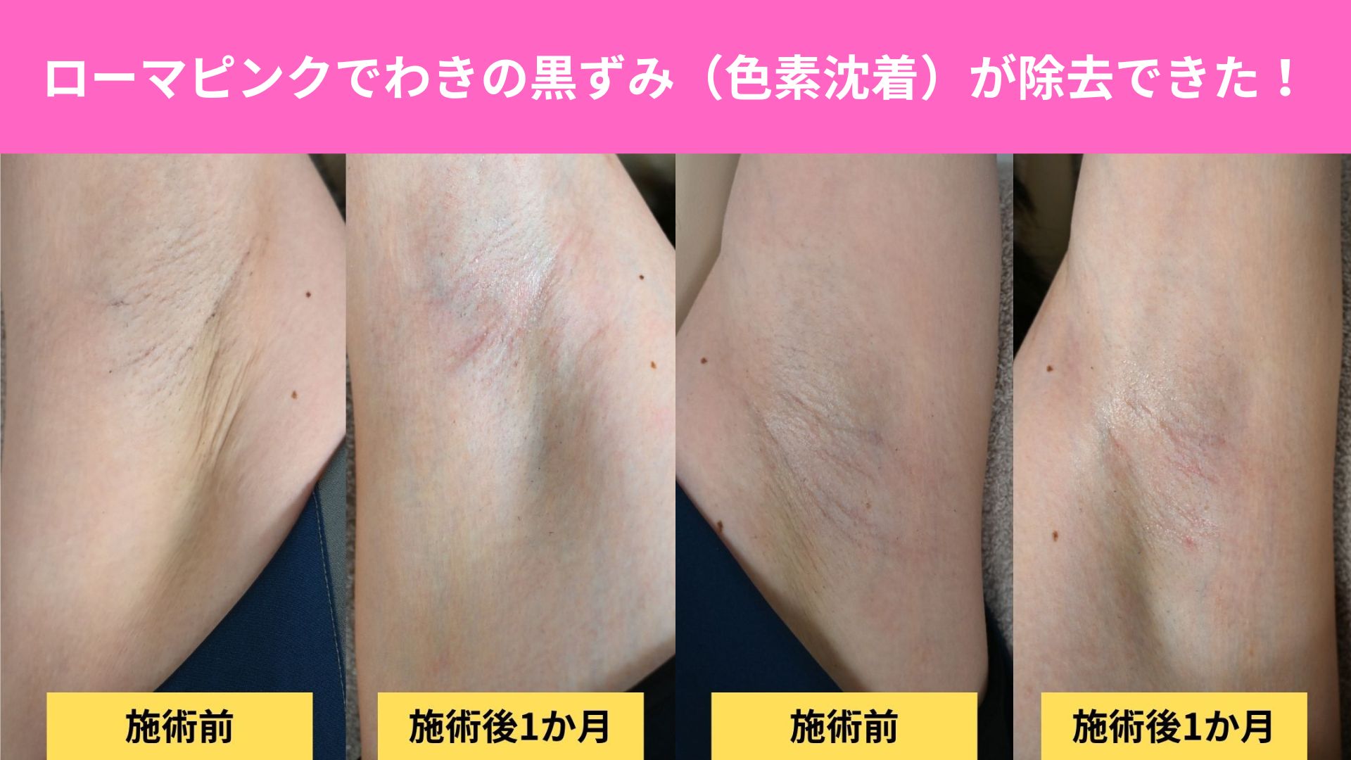 脇 の 黒ずみ
