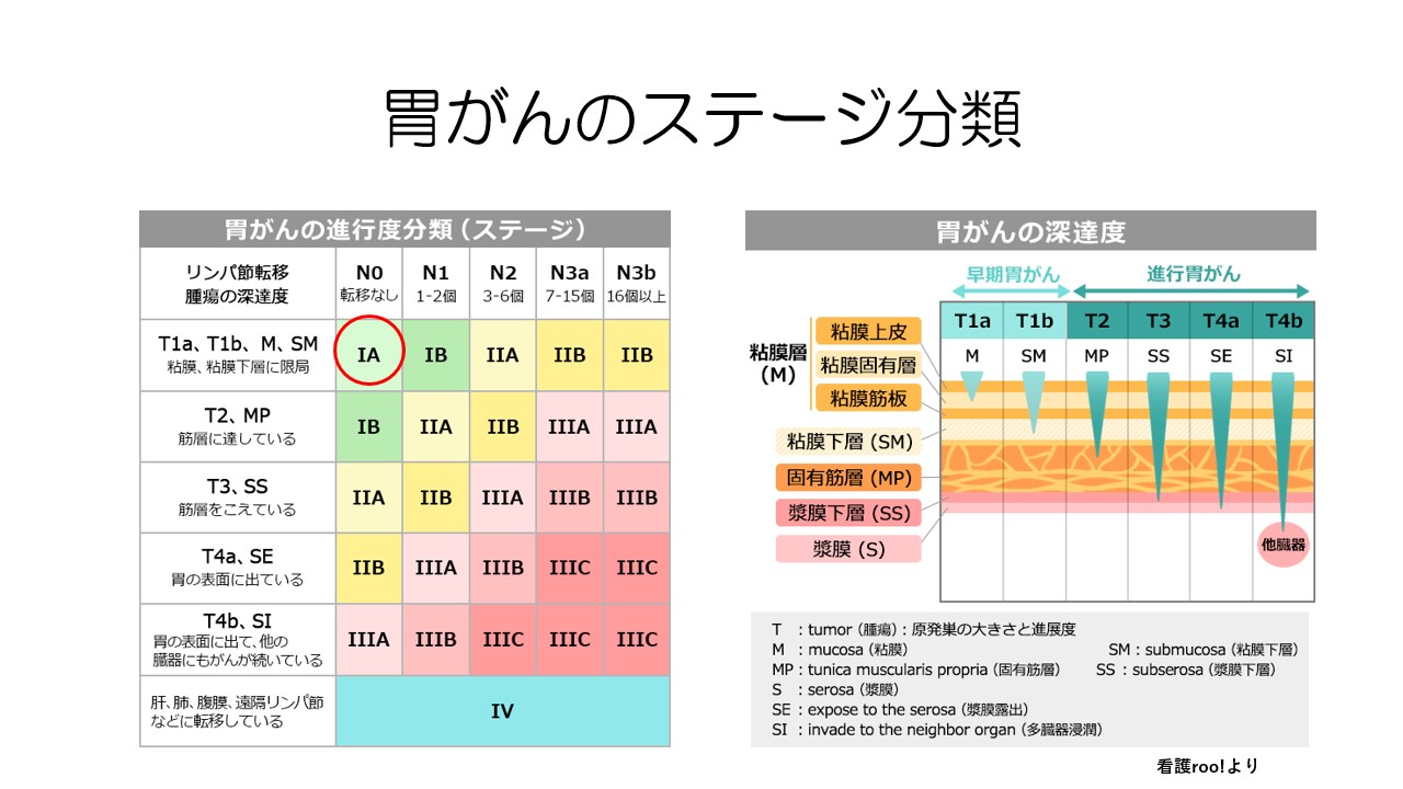 胃がん最新治療を全解説 / 内視鏡手術 / 胃切除術 / ピロリ菌 / 免疫療法 / スキルス胃がん / 食道胃接合部がん