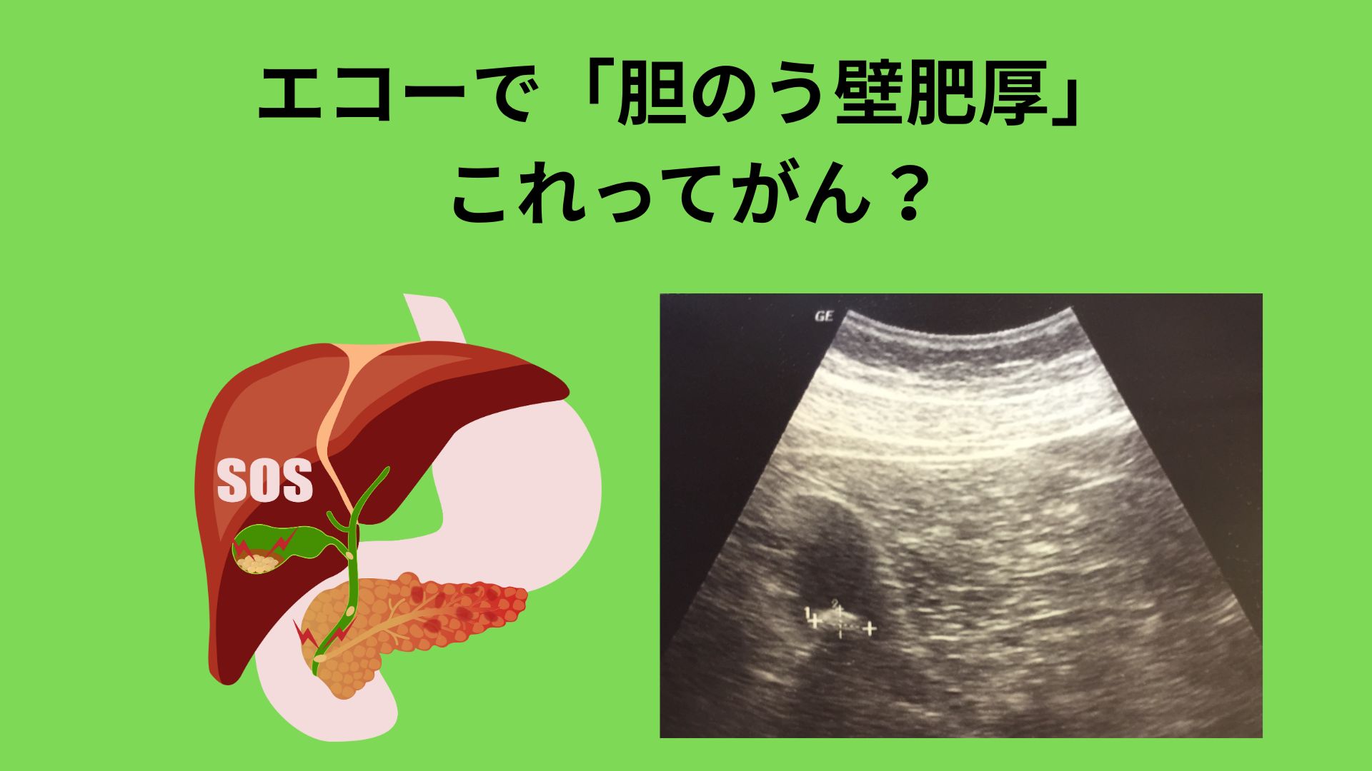 エコーで「胆のう壁肥厚」 これってがん？